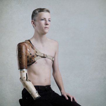 Cameron and the prosthetic arm