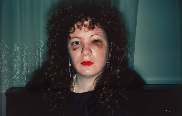 Nan after being battered, 1984